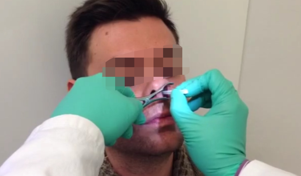 Nasal Scraping Dispositivo per prelievo citologico Ep medica