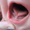 Tongue Lifter - Device for lingual frenulum - immagine 4