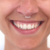 Nas-Air - Nasal dilator - Image 3